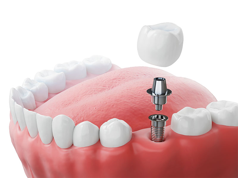 Keramikimplantat einsetzen beim Zahnarzt in Lindau